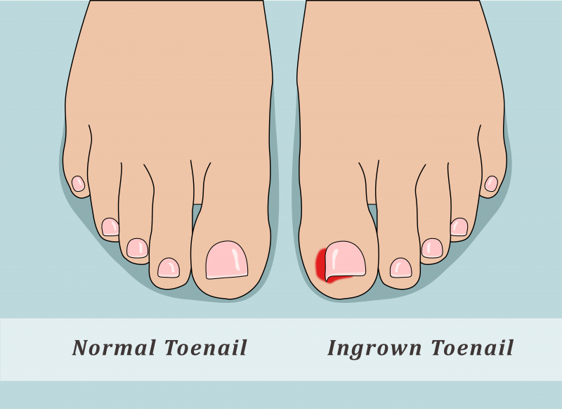 Ingrown toenail non-invasive treatment - The Foot Group